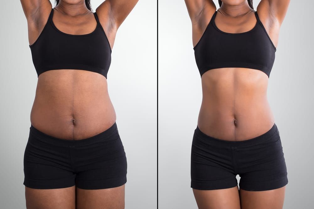 Aix les bains abdominoplastie