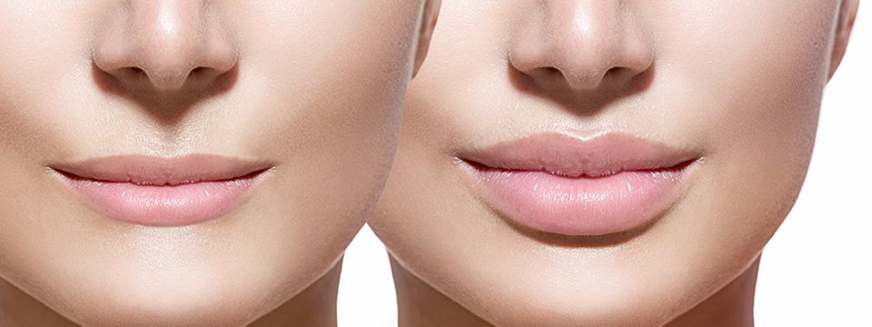 lip injection - hyaluronic acid