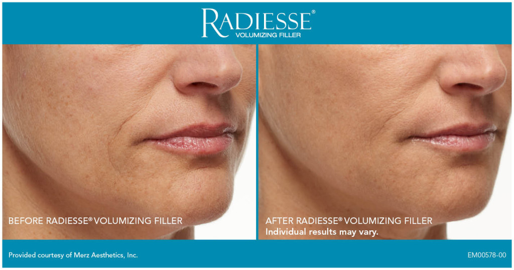 Clinique-du-lac-geneva-cosmetic-center-before-after-injections-radiesse